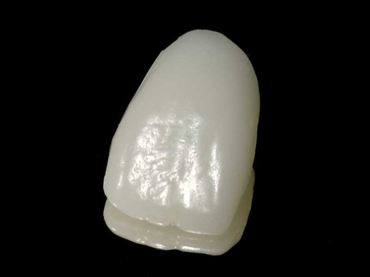 ANTERIORES VENEERS einzelne Zahnform