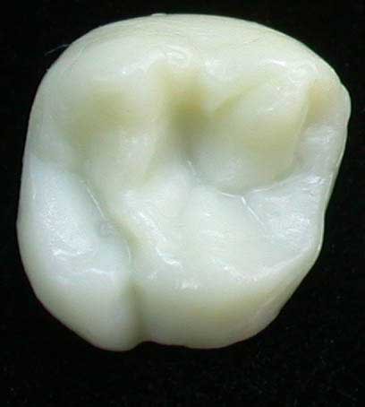 Wax-up Gnathos einzelne Zahnform