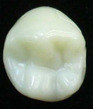 Wax-up Gnathos einzelne Zahnform
